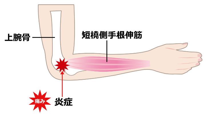 テニス肘 上腕骨外側上顆炎 ふなこし足の治療院 医師推薦 目黒区 池尻大橋で足 脚 の痛みといえばふなこし足の治療院